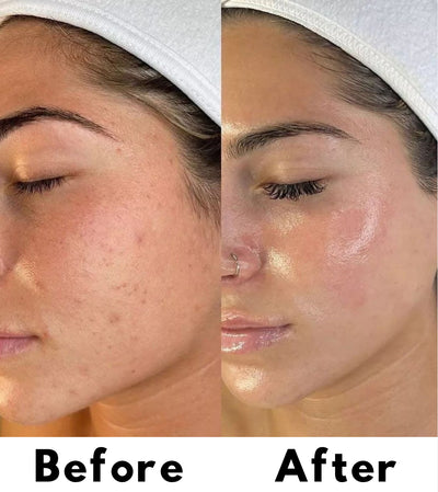 Liquid Micro needling Spicule Serum
