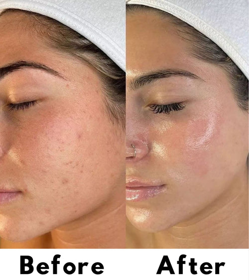 Liquid Micro needling Spicule Serum