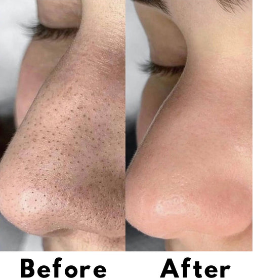 Liquid Micro needling Spicule Serum